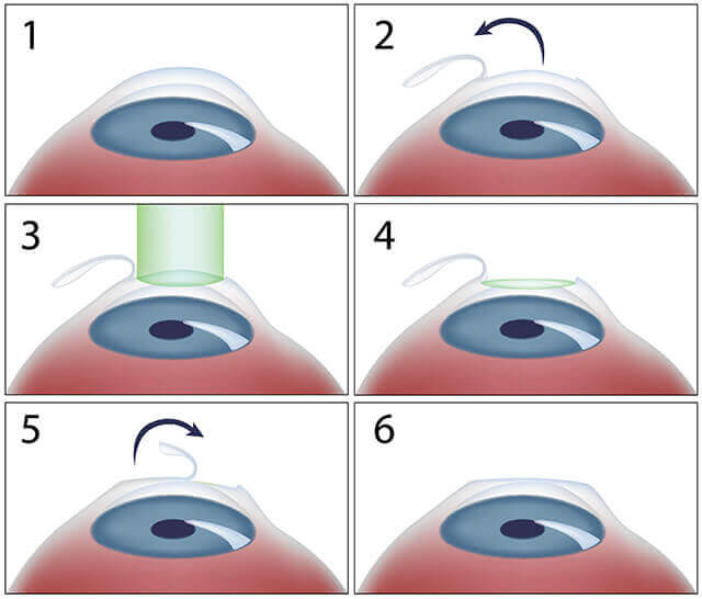 LASIK Eye Surgery Greenfield LASIK Athol Eye Center