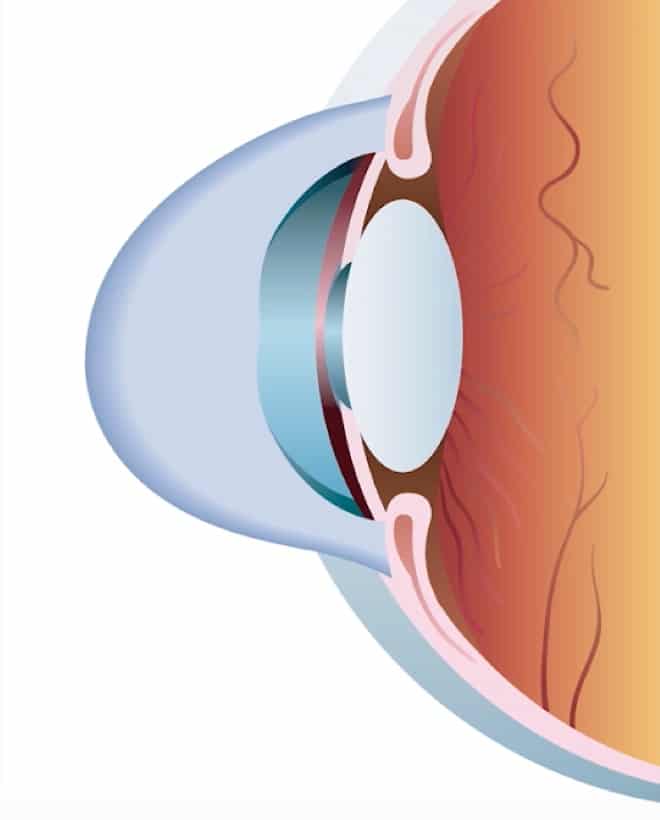 Keratoconus Treatment in Houston Eye Center of Texas