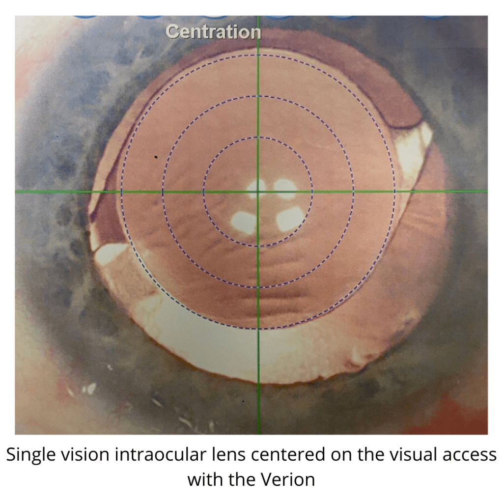 Cataract Surgery Chicago Cataract Treatment Hoffman Estates