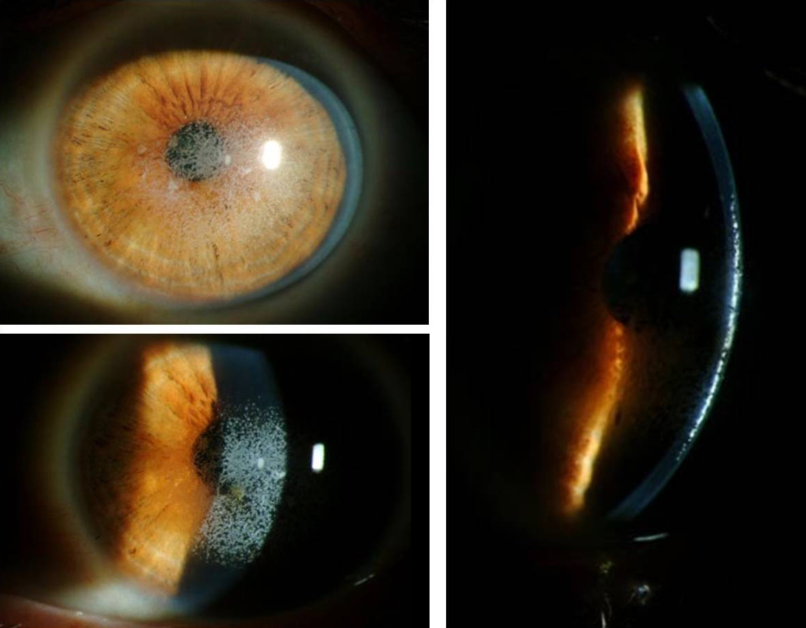 PostLASIK Granular Corneal Dystrophy