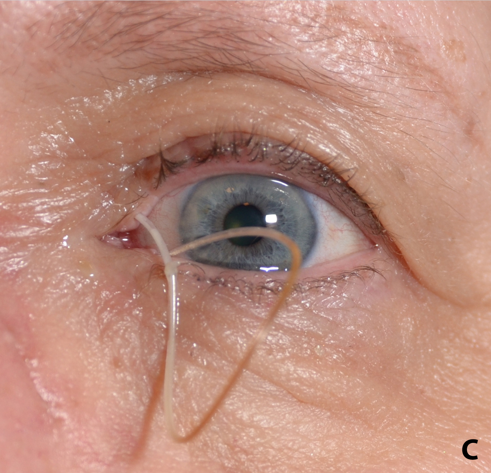 Nasolacrimal Stents An Introductory Guide