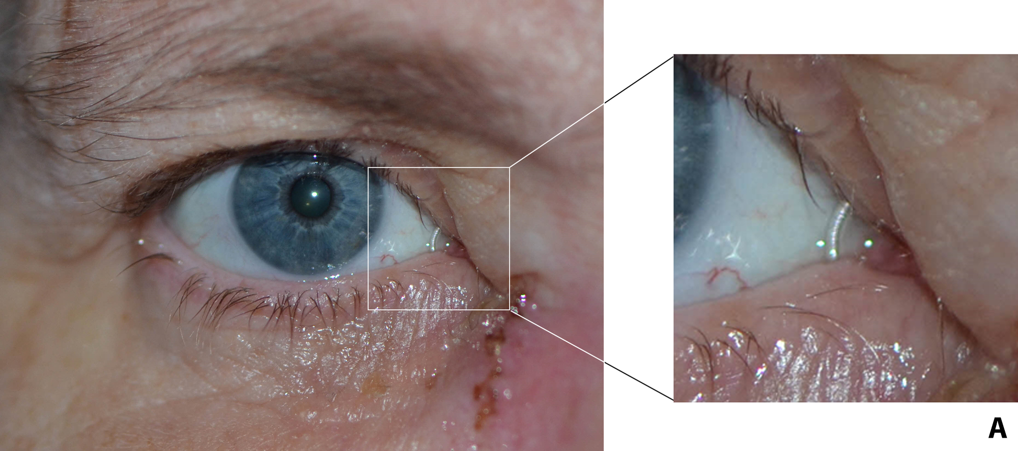 Nasolacrimal Stents An Introductory Guide