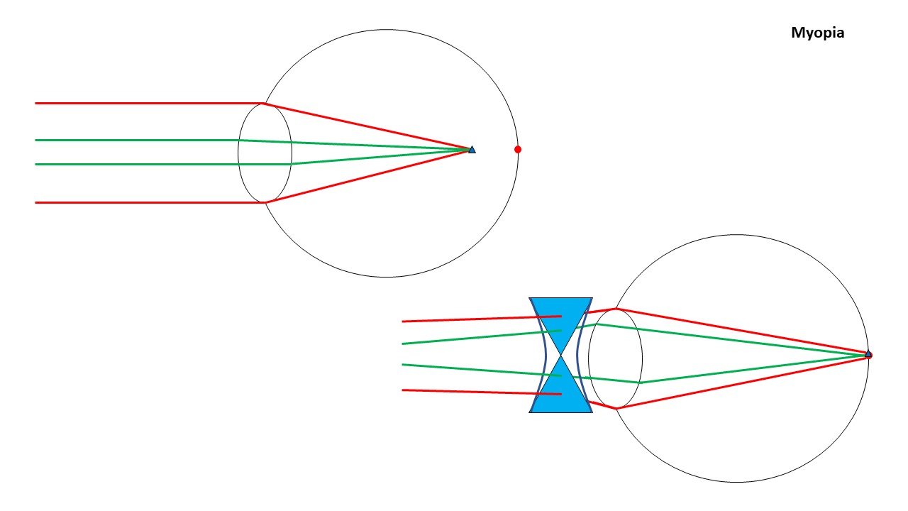 Longsightedness and Shortsightedness Eye Solutions