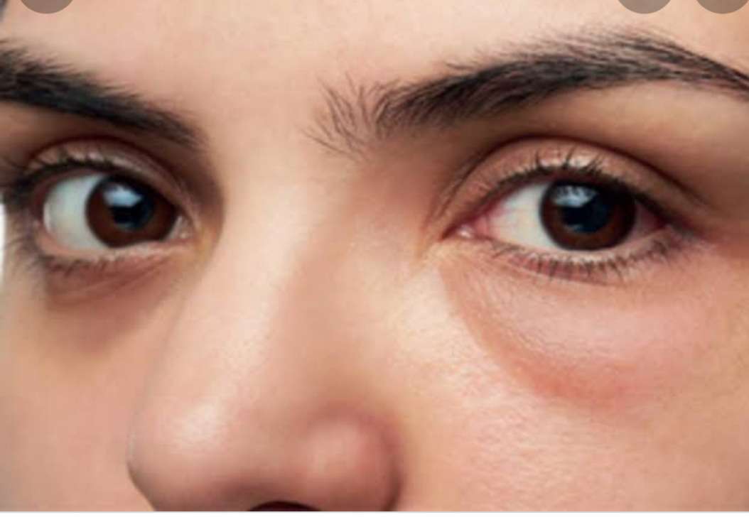 Make up for puffy eyes Eye Solutions Mumbai Chennai