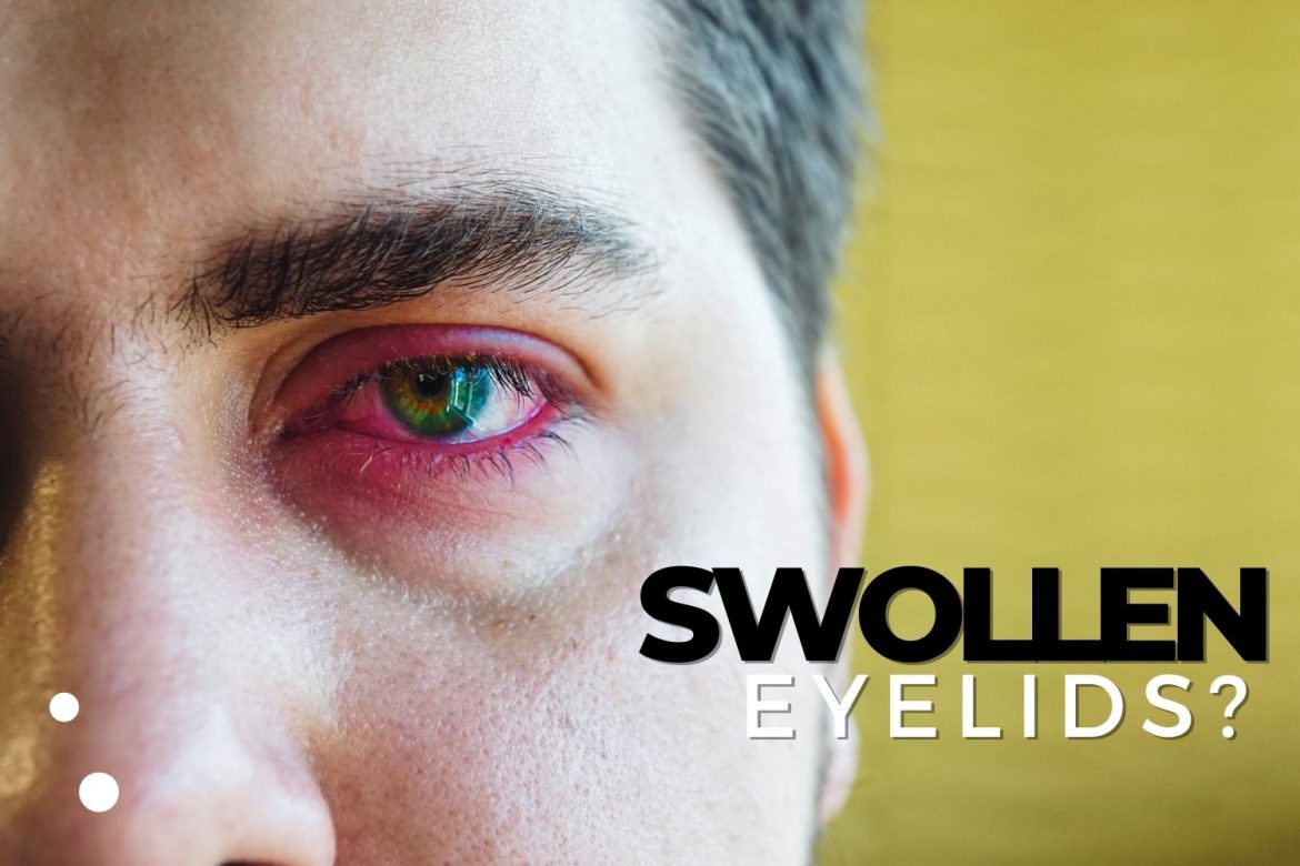 The Many Causes of Swollen Eyelids — And What You Should Do EZOnTheEyes
