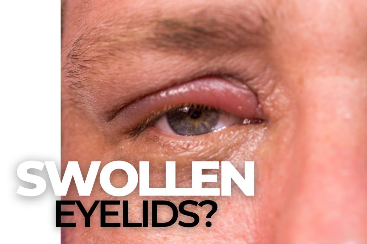 Blepharitis The Most Common Cause of Dry Eye EZOnTheEyes