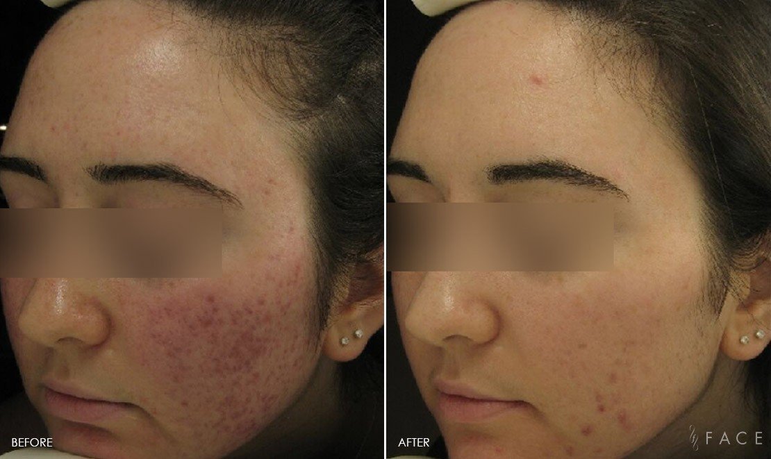 Uneven Skin Tone Birmingham Skin Texture Oakland County MI Face