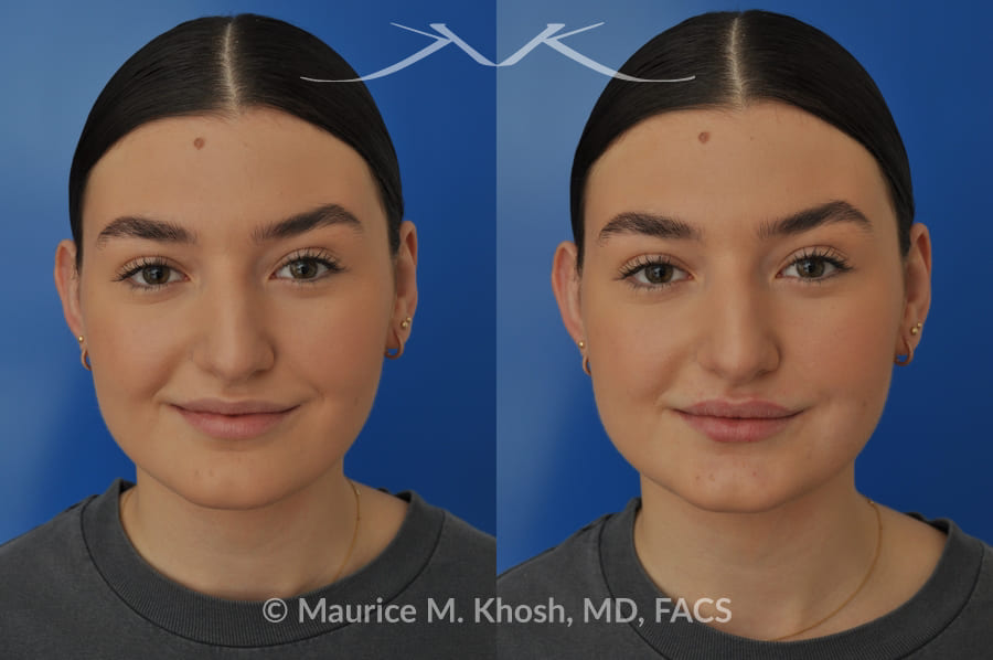NYC Lip Enhancement Before and After Photos Lip Lift, Augmentation