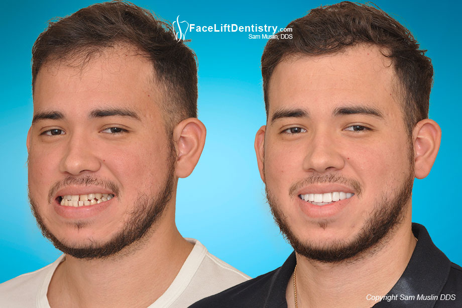 Overbite Correction Cost