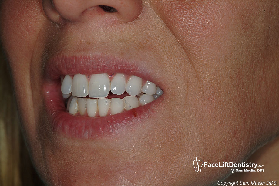 Open Bite Correction without Jaw Surgery