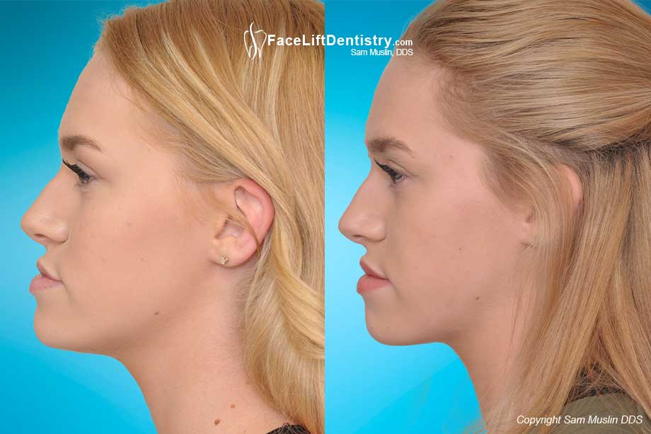 Underbite Correction without Surgery, no Braces no Aligners