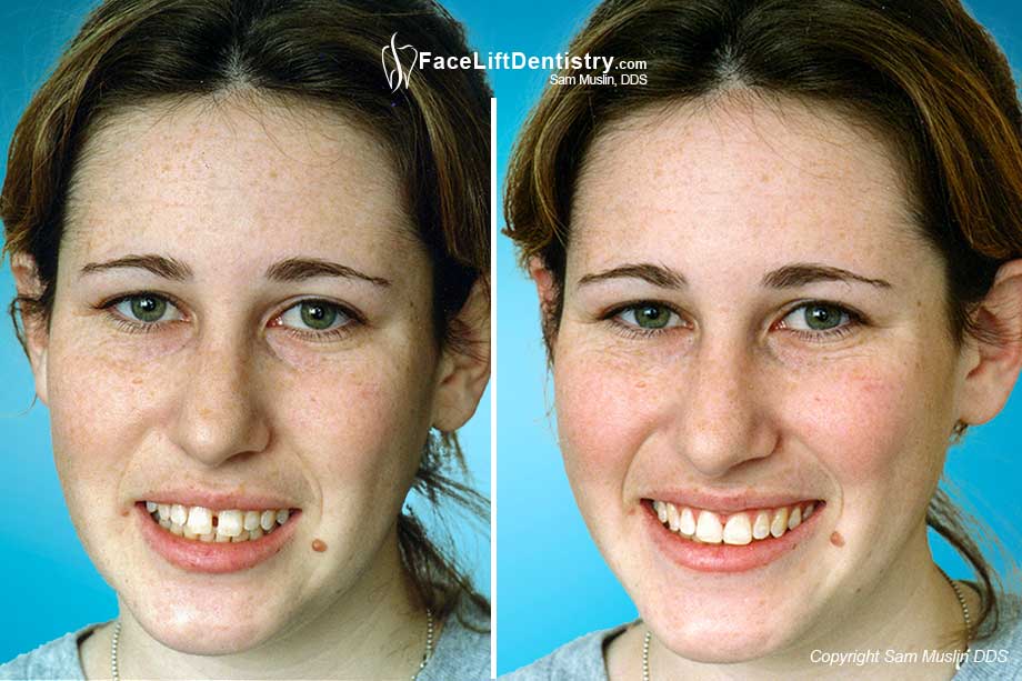 Gaps Between Teeth Cosmetic Bonding and Aesthetic ReShaping