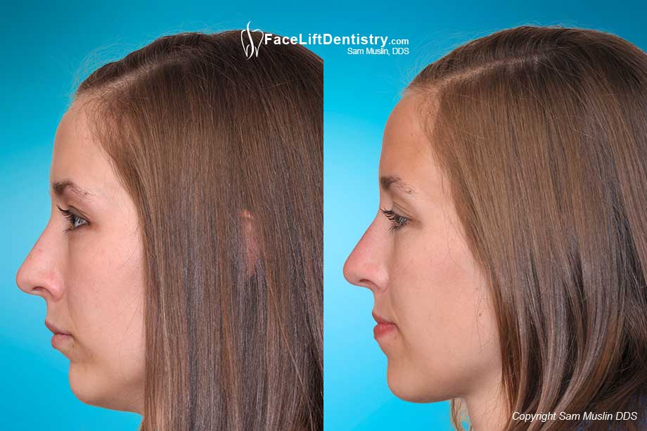 NoSurgery Bite Correction, Mouth Reconstruction, Face Lifts
