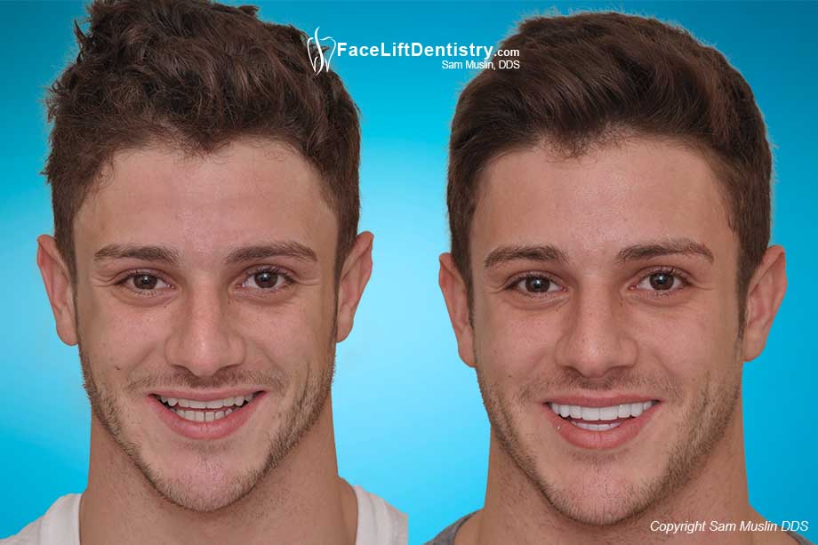 Face Lift Dentistry® The Future of Bite Correction