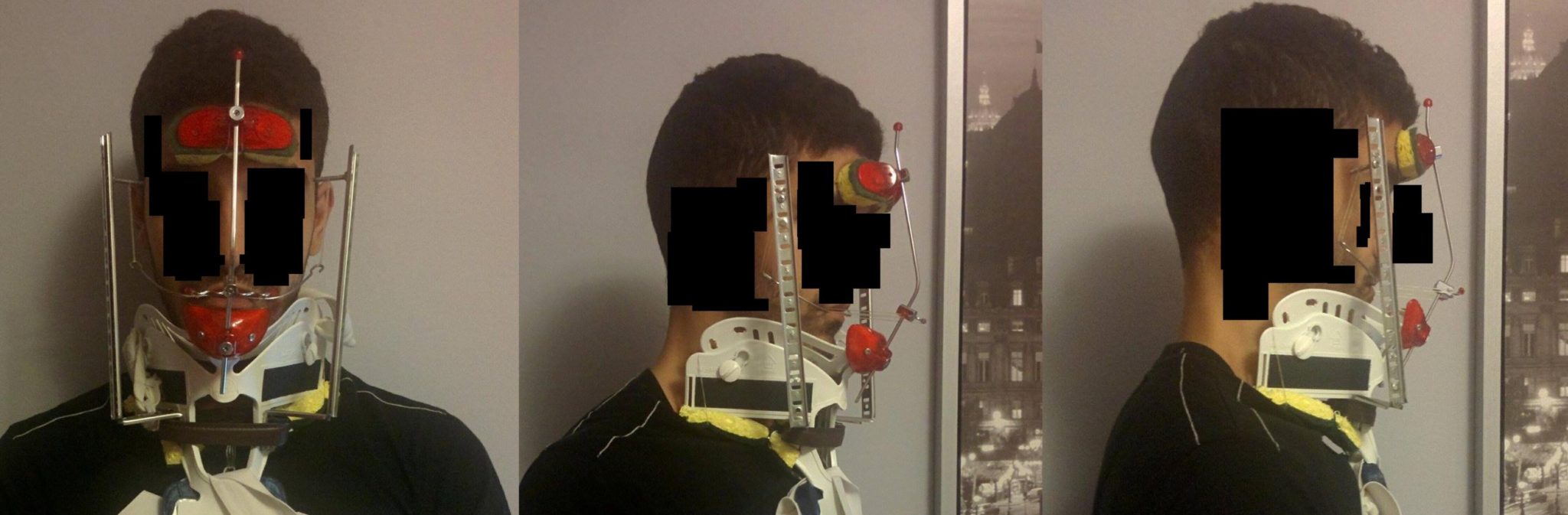 Orthodontic Headgear Facepulling headgears for adults