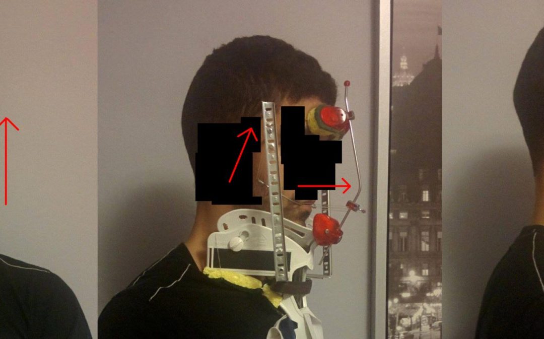 New Face Pulling Device Face Pulling Maxilla Protraction and