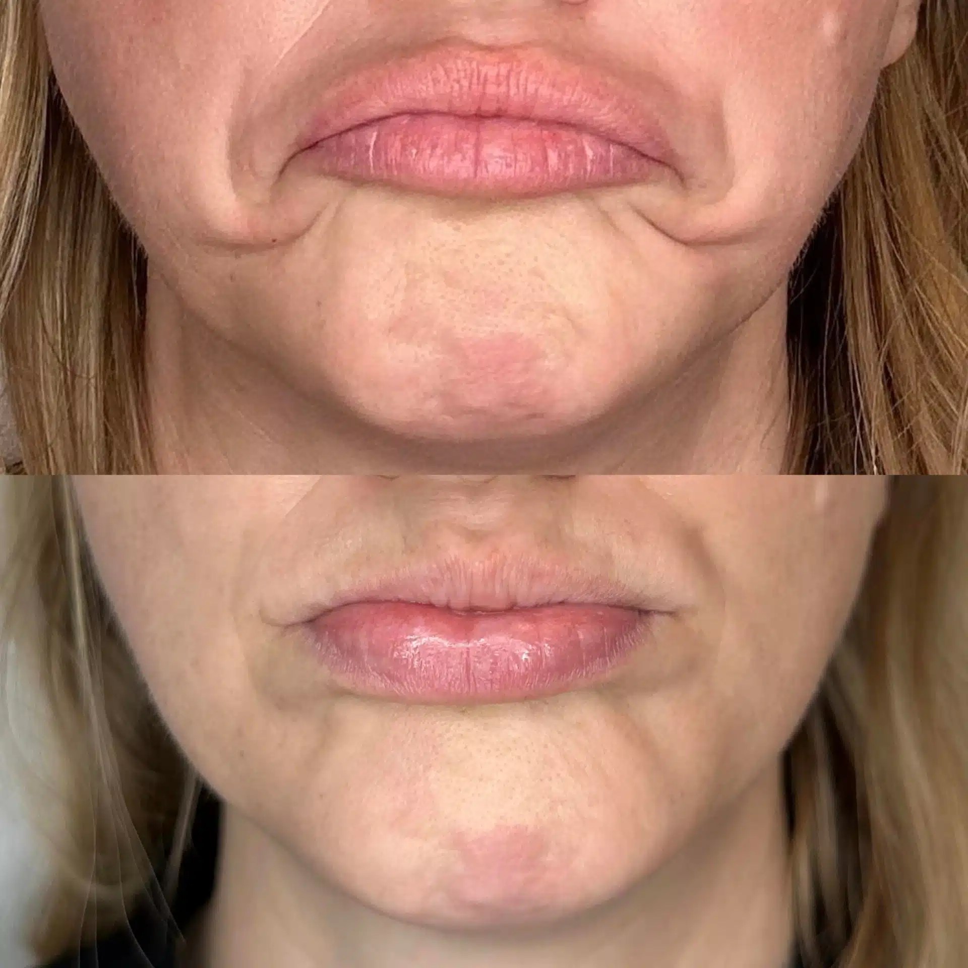 Fort Collins, CO Botox & Dysport Get A 30Min Consultation