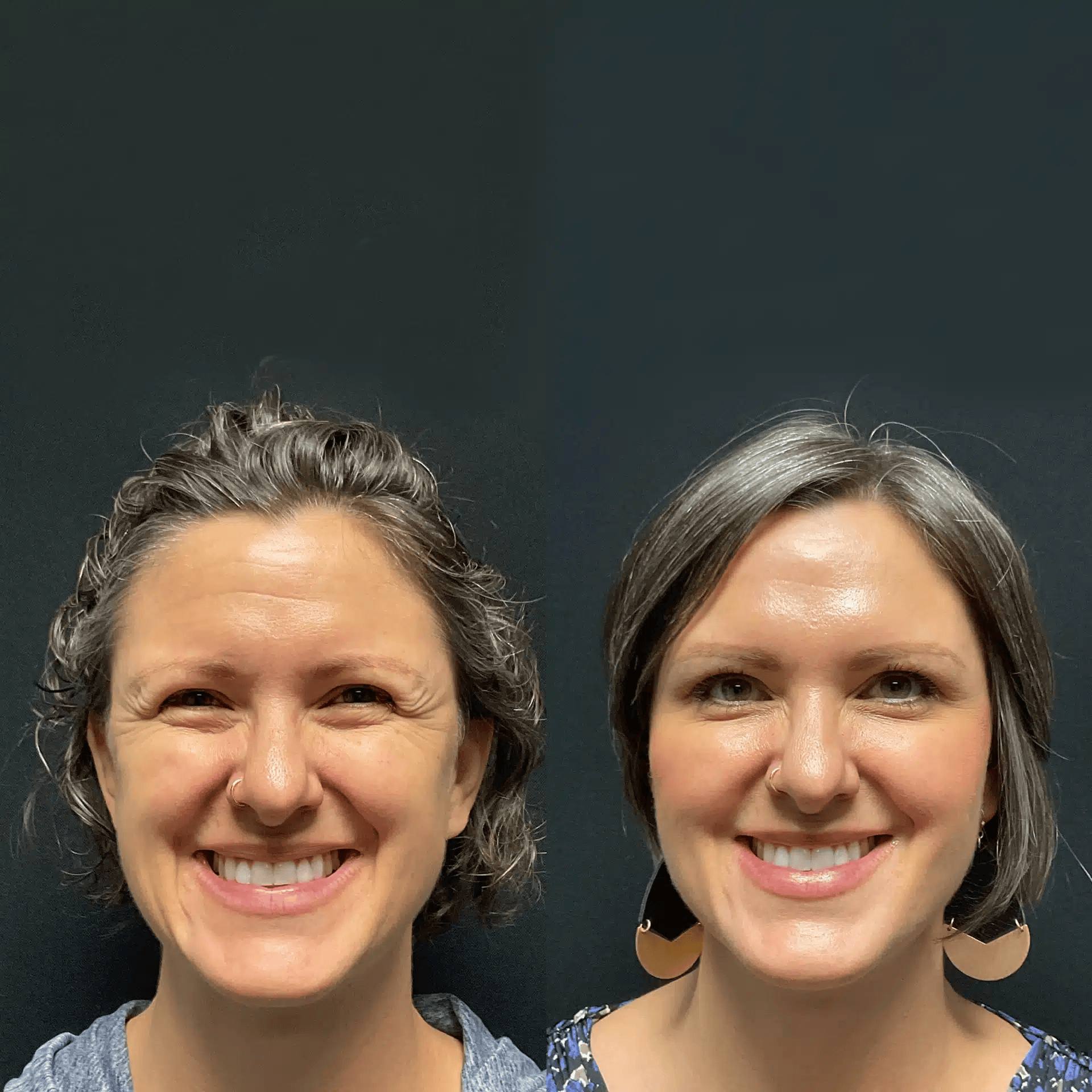 Fort Collins, CO Botox & Dysport Get A 30Min Consultation