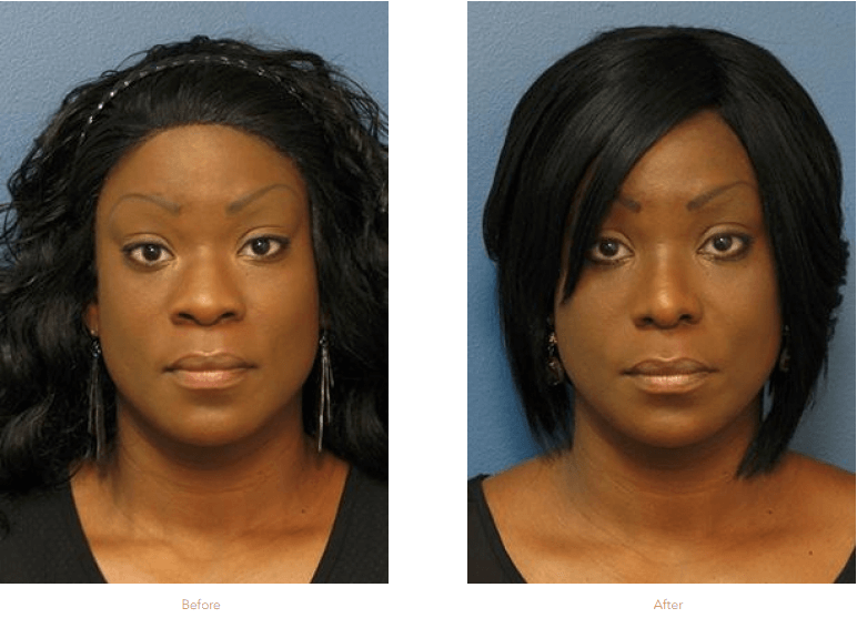 What is an Ethnic Rhinoplasty? Raleigh Rhinoplasty Stein Plastic