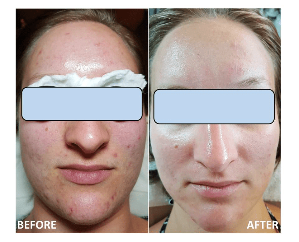 CELLUMA LED TREATMENTS