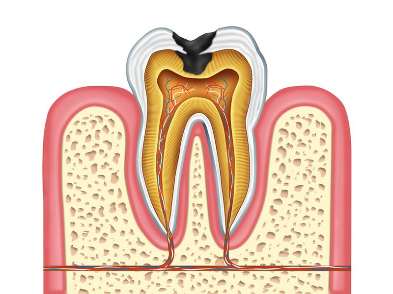 Pictures Of Cavities 14 187 Tooth Decay Stock Photos