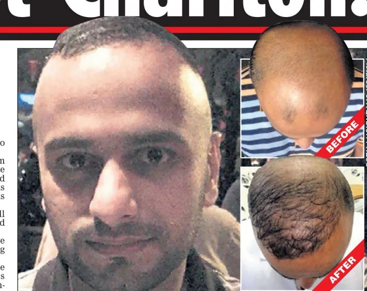 Considering A Cheap Hair Transplant? Think Again