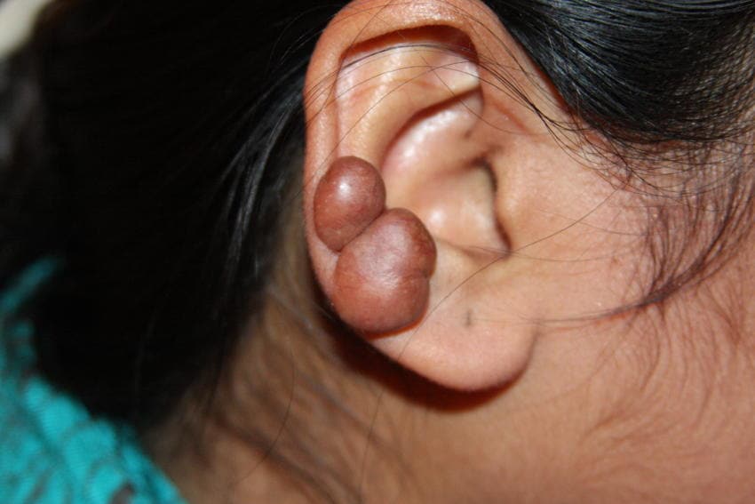 Cicatrice cheloide cosa sono, immagini e cura