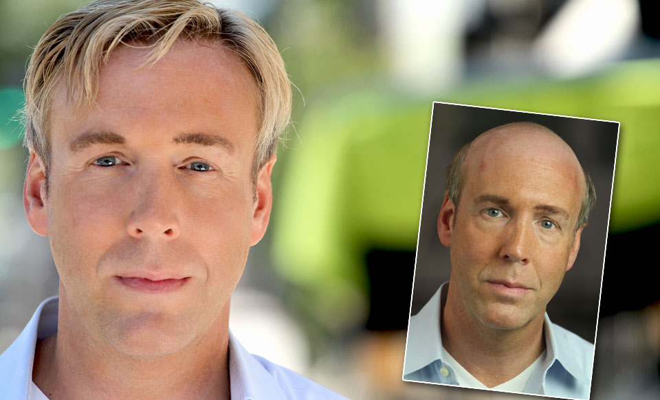 Hair Replacement Atlanta