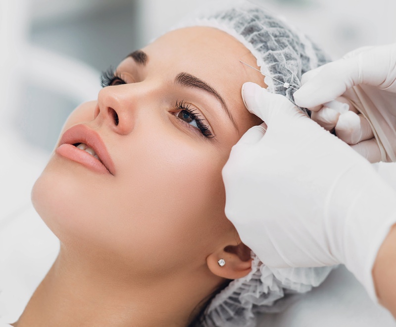 Thread Lift in Singapore The Advantages of Dissolvable Threads