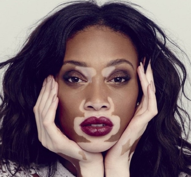 Vitiligo Curable or Not? FavoritePlus