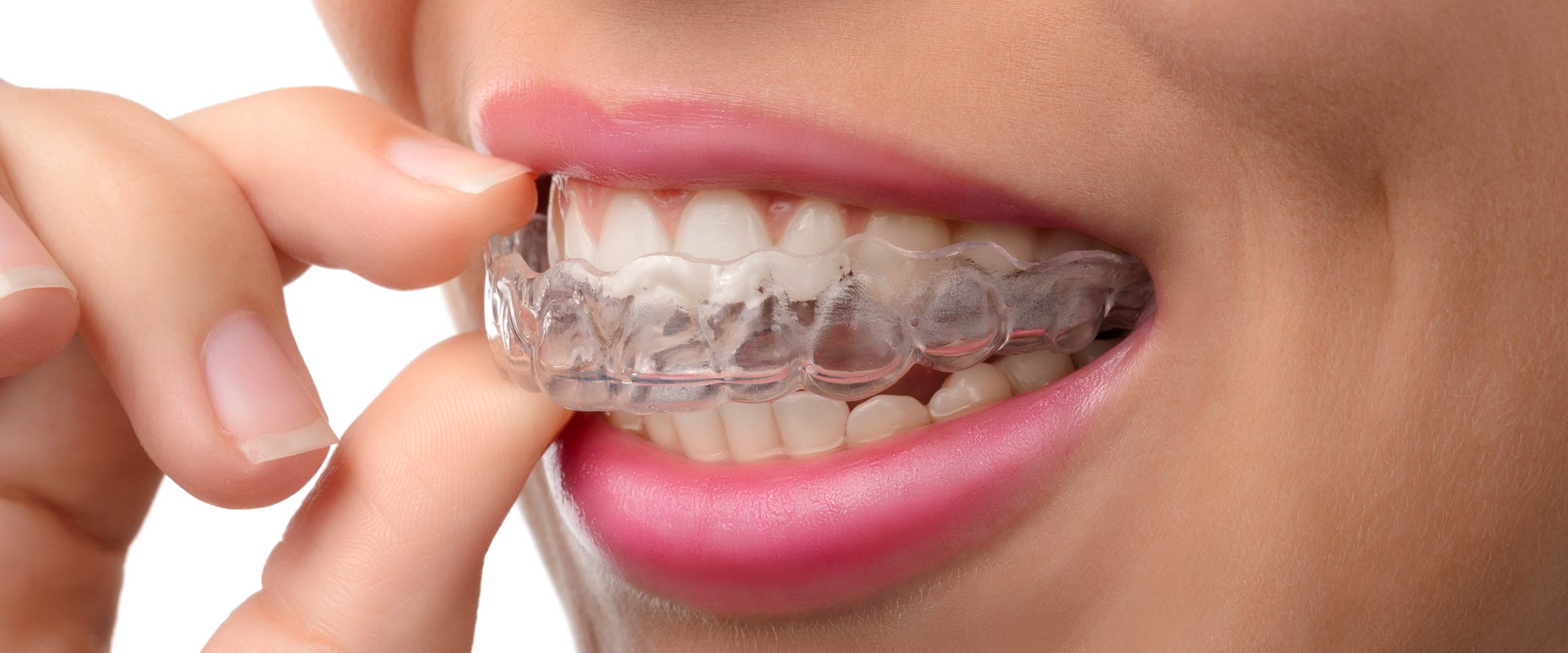 Various kinds of dental braces and their purpose Family Dental Centre