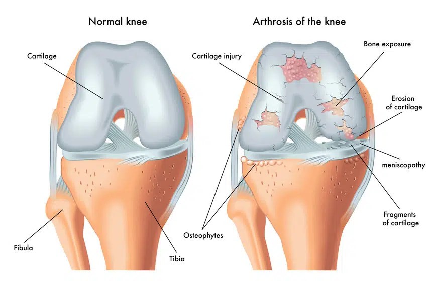 7 Best Exercises For Bone On Bone Knee Pain Relief Feel Good Life