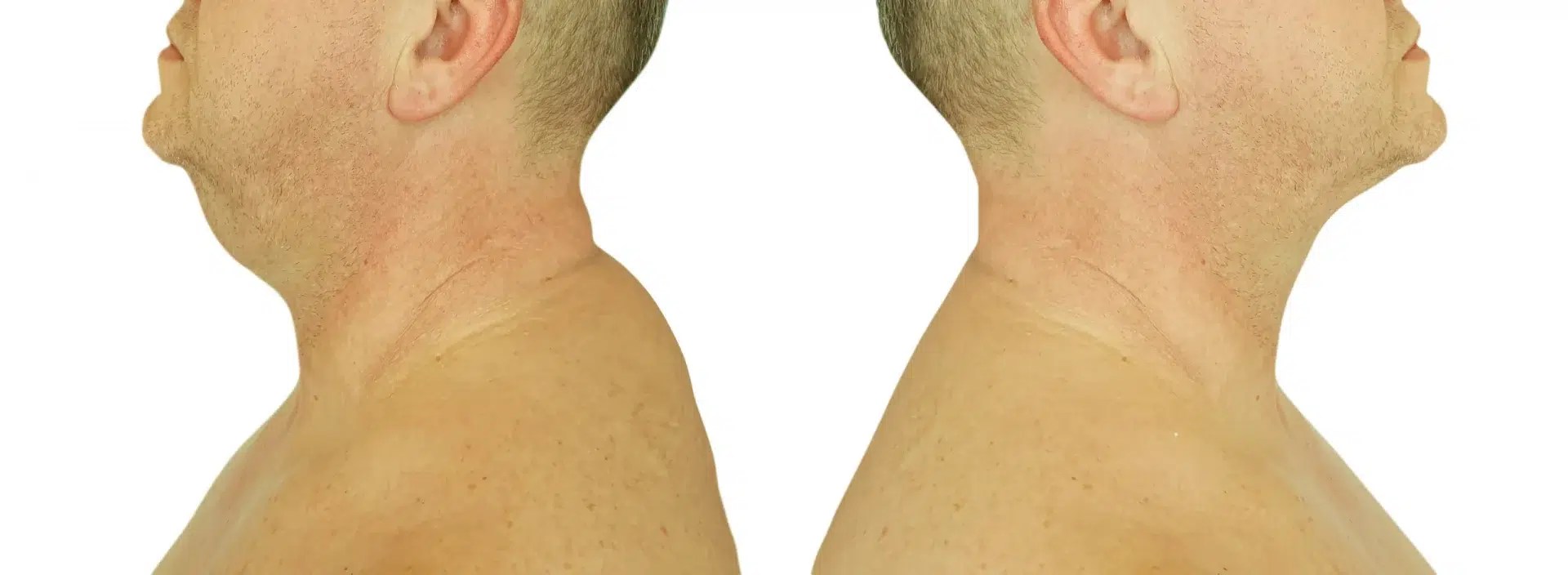 How To Get Rid Of Buffalo Hump Naturally Feel Good Life