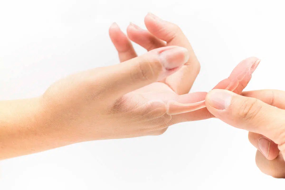 Finger Sprain Rehab Exercises Feel Good Life