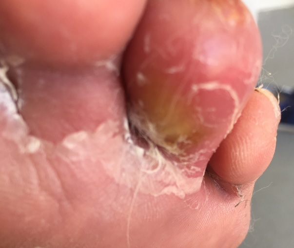 How will I know if I have an infection? Feel Your Feet