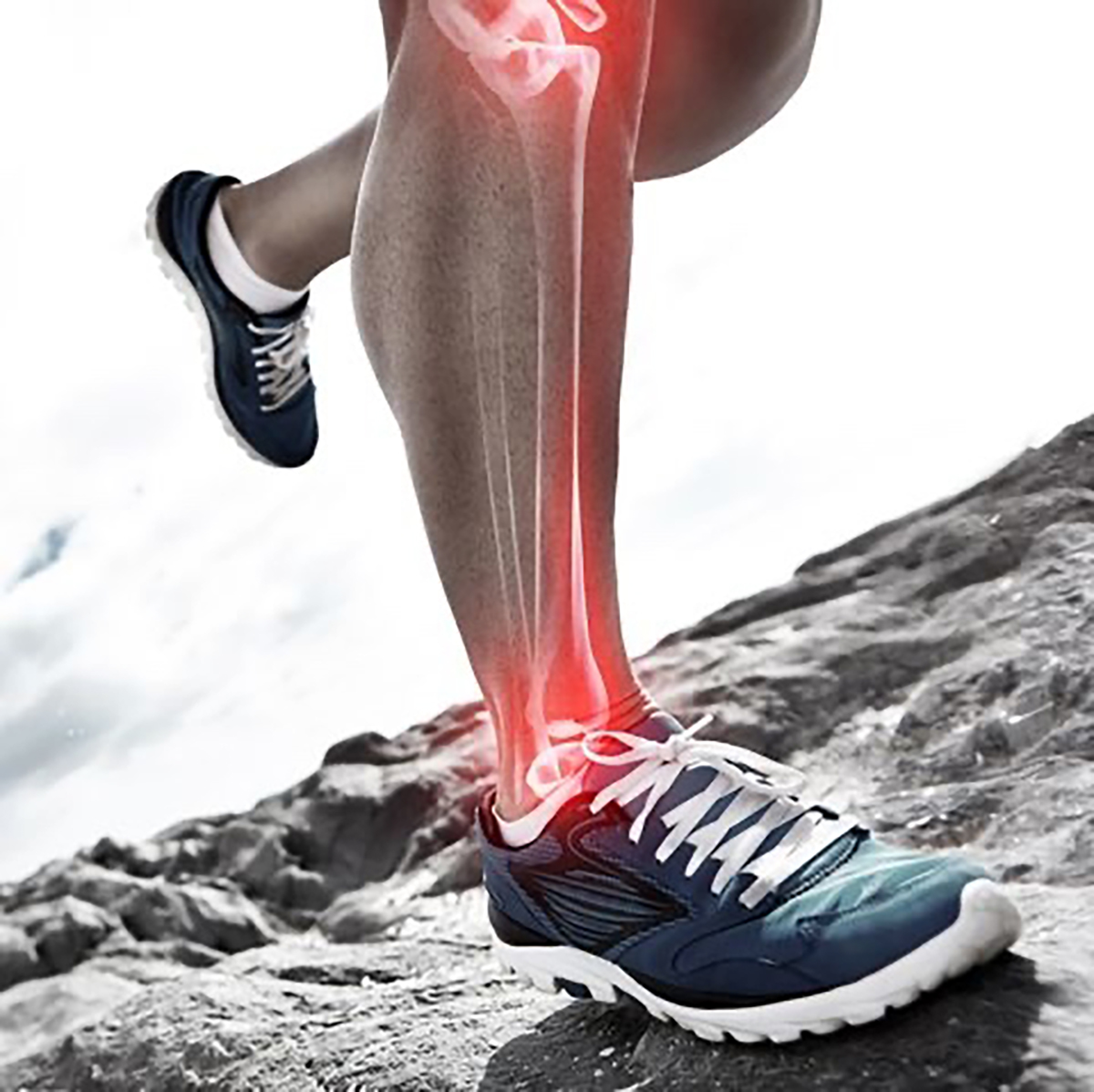 Bone Stress Injuries High Risk vs Low Risk Learn The Difference