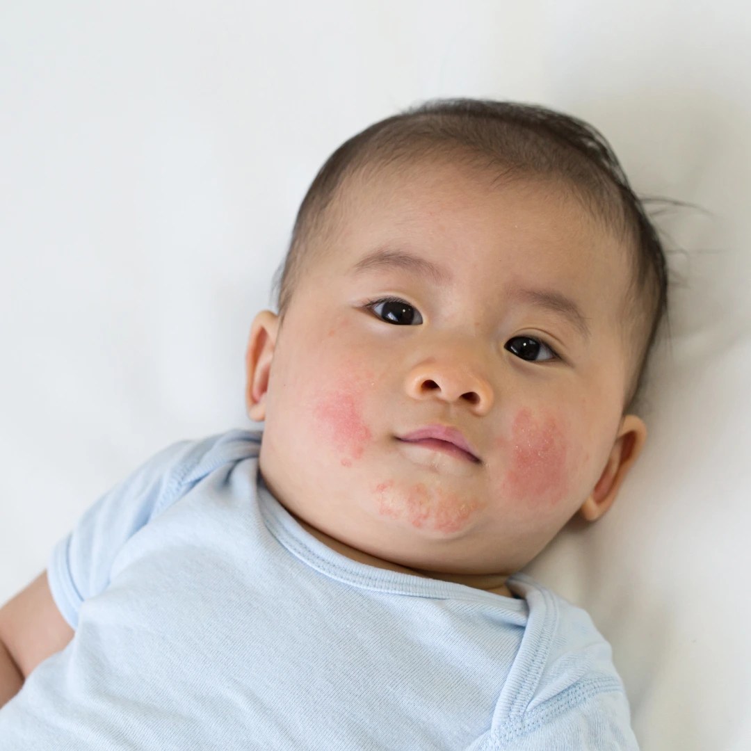 What can I do for eczema? Fertile Ground Health Group