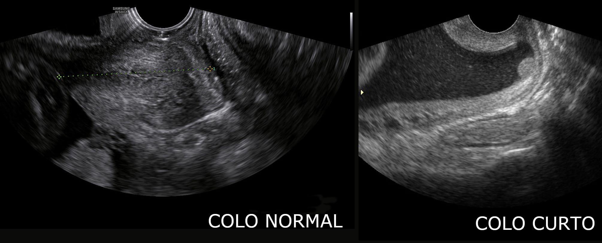 O que é a medida do colo uterino na gravidez? Fetalmed Medicina Fetal