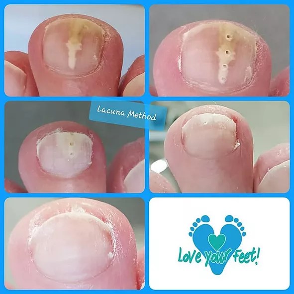 REVIEW] EMTRIX FUNGAL NAIL TREATMENT Iva's Beauty Journey, 40 OFF