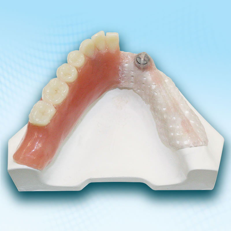 FiBER FORCE for full dentures (ideal for laboratories)