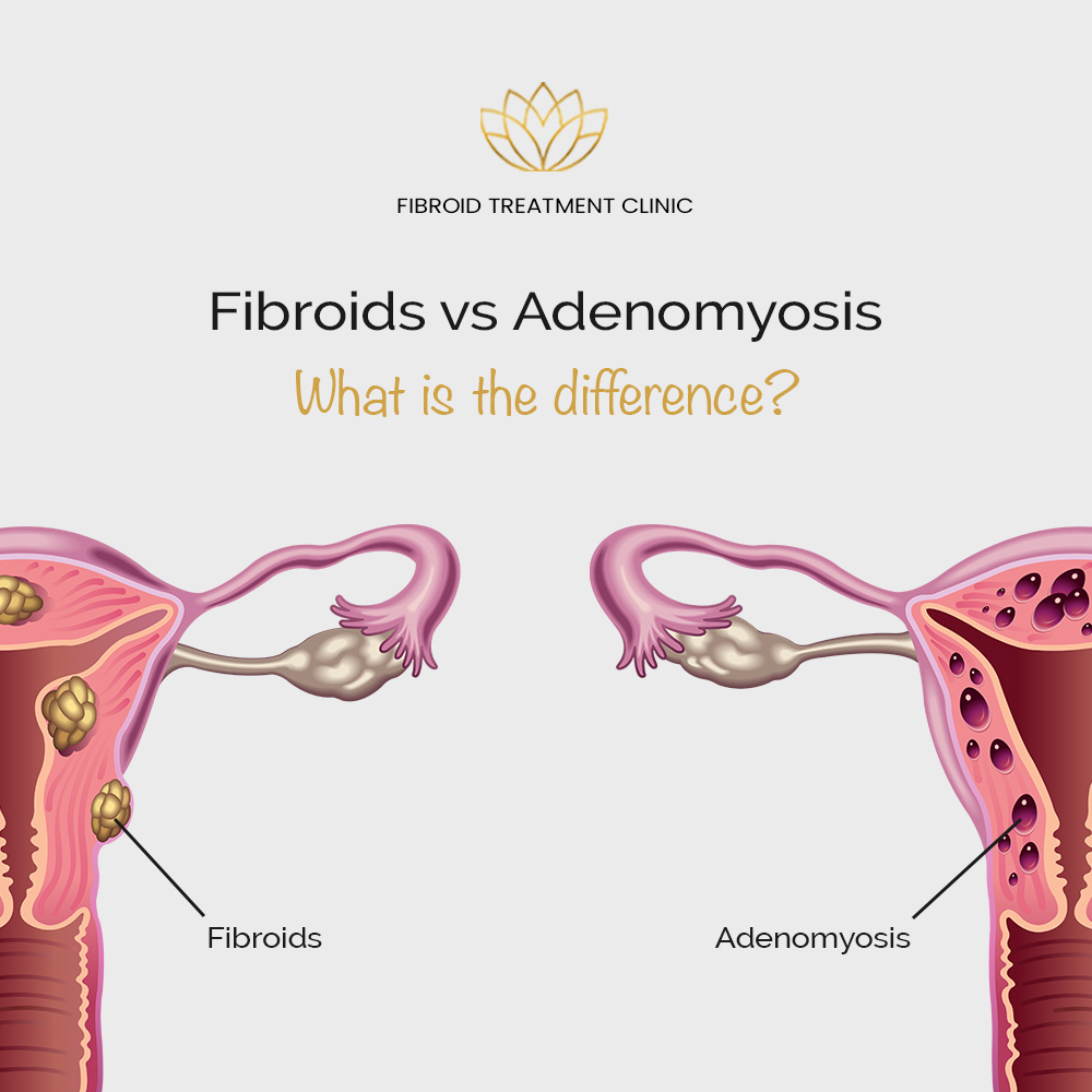 Fibroids vs Adenomyosis Fibroid Treatment Clinic