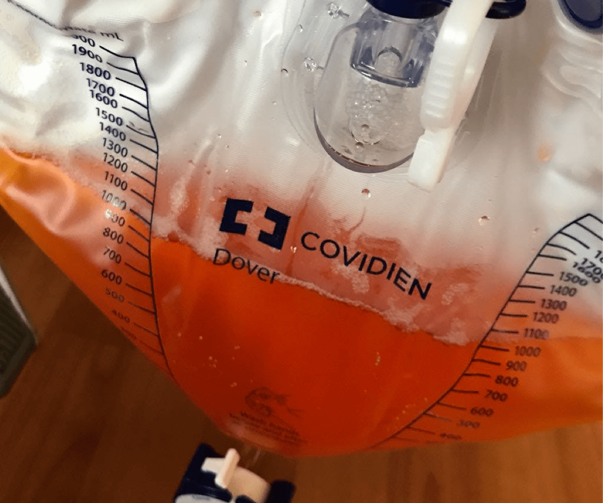 Unusual Urine Color Presentations Figure 1