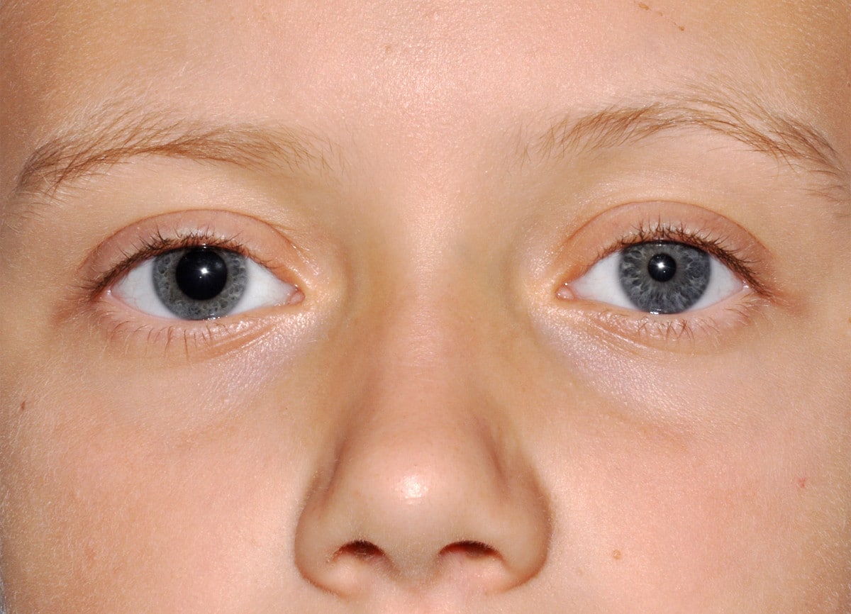 Anisocoria Operatore sociosanitario
