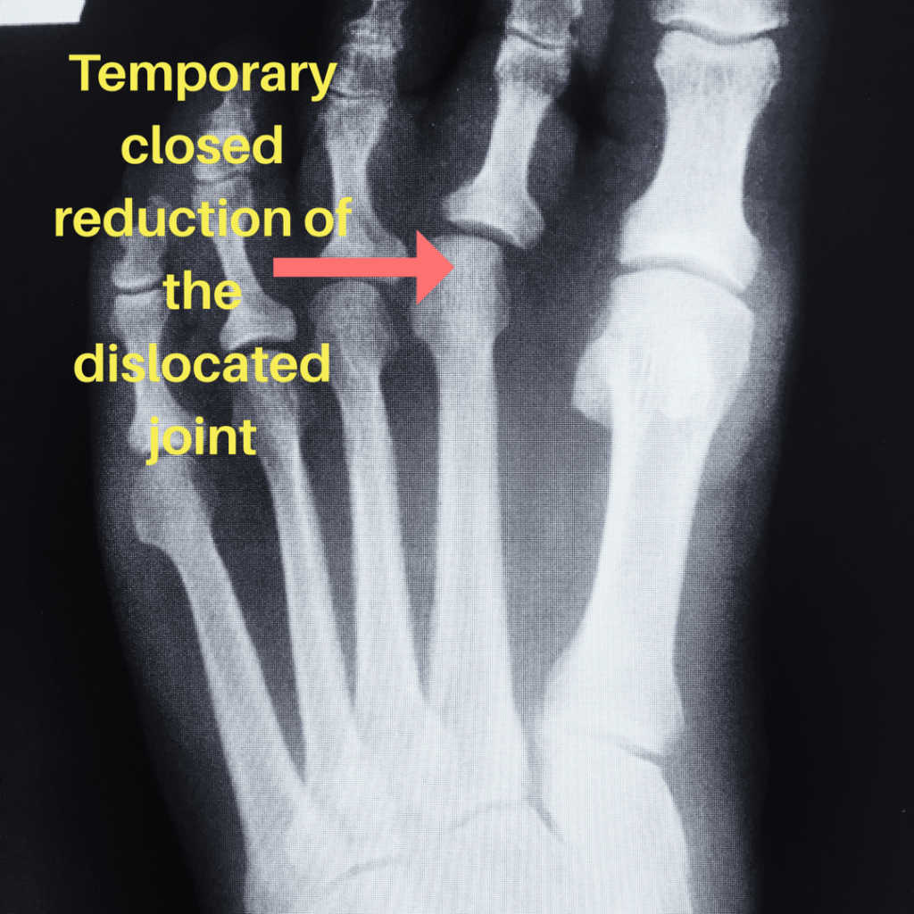 Plantar Plate Injury Final Kick Ankle and Foot Clinic Ankle and Foot