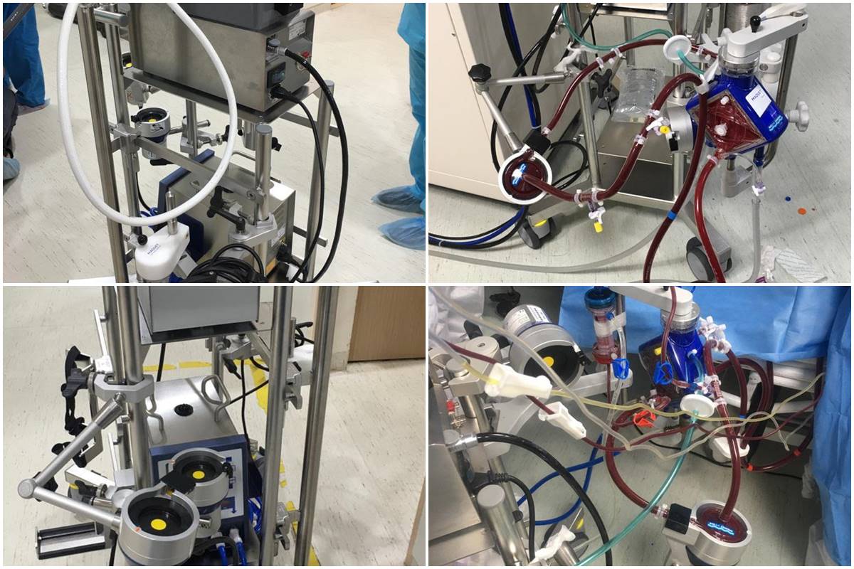 What is ECMO and how it saved many young lives during Covid19’s second