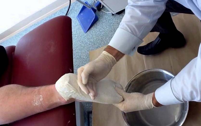 The Process of Making Custom Made Foot Orthoses Casting to Fitting