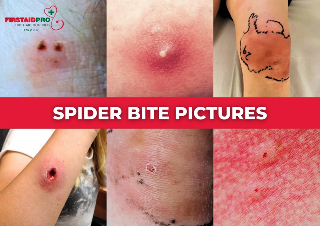Spider bites When to worry, Symptoms & First Aid