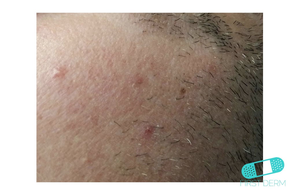 Rosacea Hudläkare på nätet