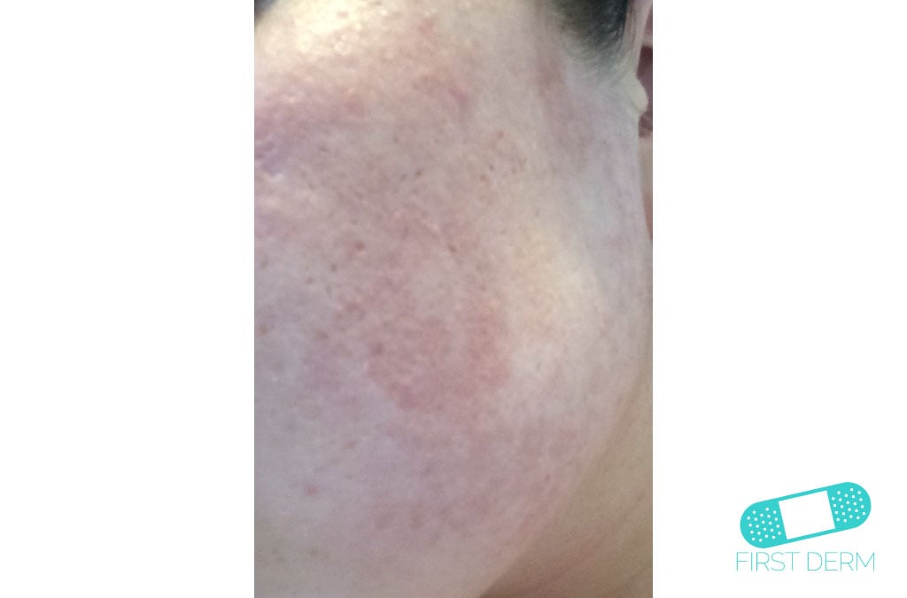Rosacea Hudläkare på nätet
