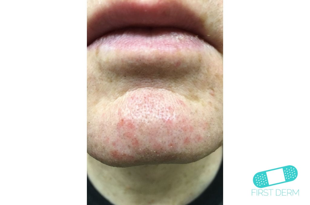 Rosacea Hudläkare på nätet